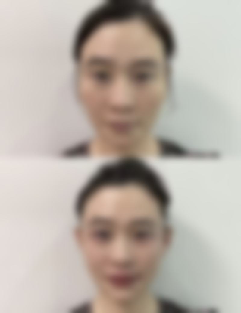 孙忠林医生面部整形实例