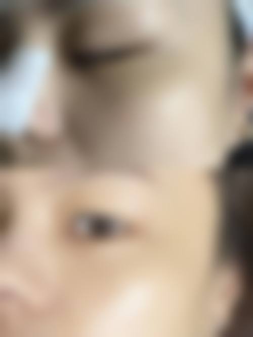 尹晓晴医生皮肤美容实例