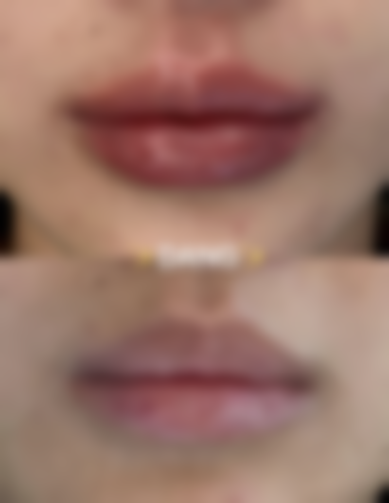 隆胸选300cc假体到底大不大？综合考量更重要