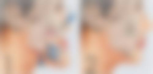 脂肪隆胸修复时长揭秘！术后修复注意事项