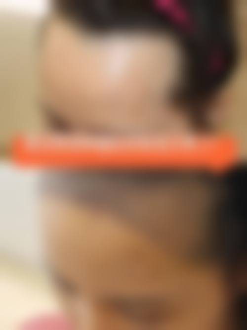 五、哈尔滨大麦植发（原科发源）实例