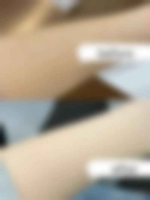 陈(璐)平医生双眼皮手术实例