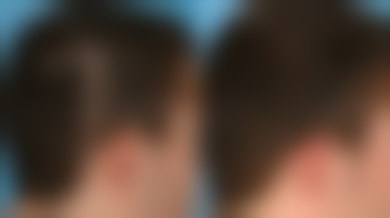 黄在英医生痤疮治疗怎么样可靠吗？