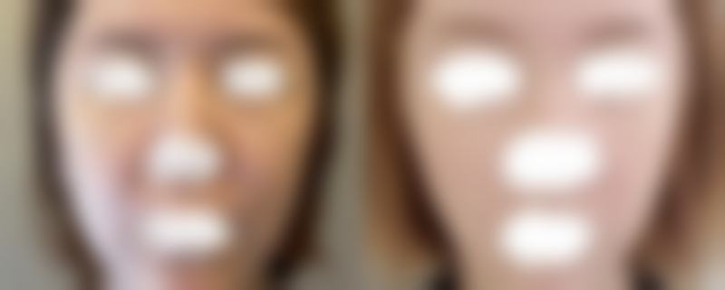 突然双眼皮肿了？过敏反应可能是元凶