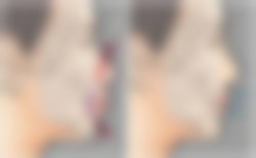 手背上的烫伤疤痕怎么去除？多种治疗方案+日常护理，淡化疤痕效果看得见 