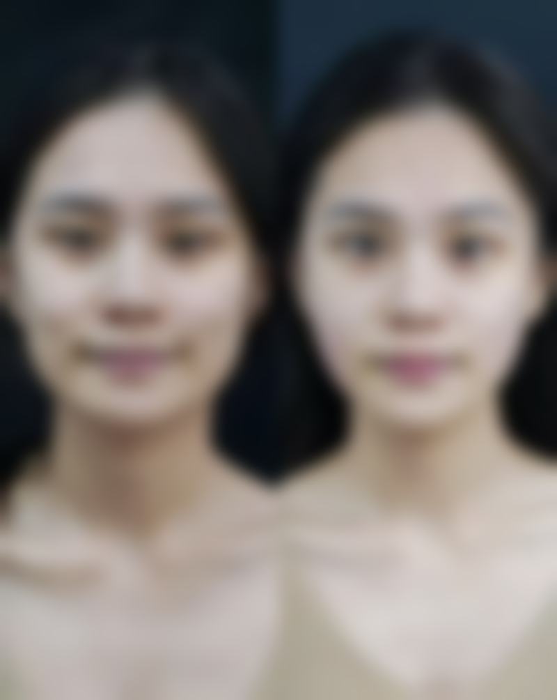 怎样才能摆脱疤痕体质困扰？多种治疗与护理手段助你淡化疤痕、抑制增生 