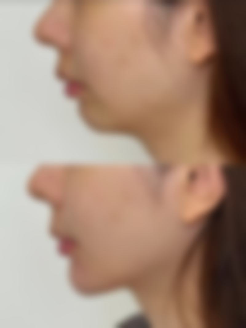 做韩式双眼皮，术后护理促修复