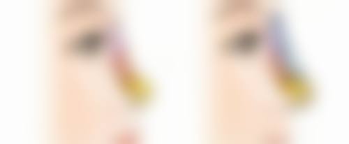 如何去除顽固眼袋？药物治疗来帮忙
