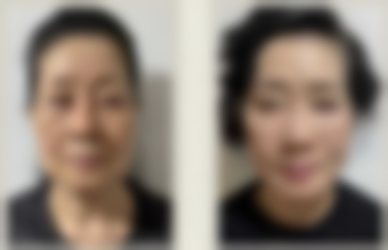 如何攻克顽固眼袋？医美治疗显神通