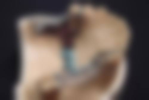 甲状腺手术疤痕怎么遮？遮盖注意事项要牢记