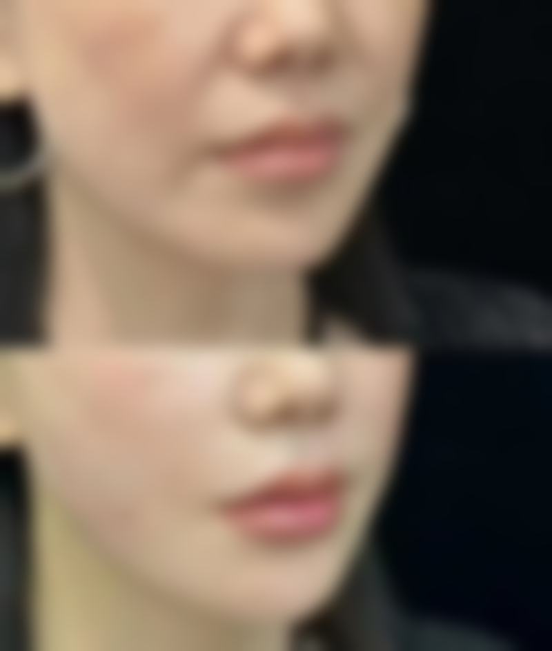 皮肤疤痕体质修复：激光治疗淡化疤痕色泽