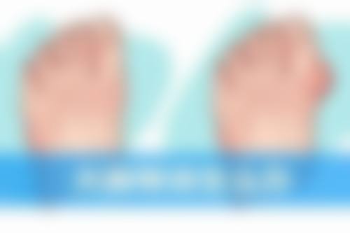 疤痕增生能用艾灸吗？艾灸带来新可能，综合护理不可少