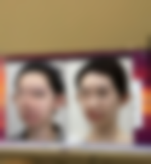 还在为痘疤无奈？物理治疗显神通