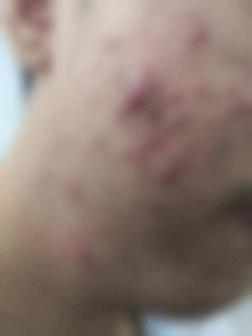 五、广东省第二中医院皮肤科实例