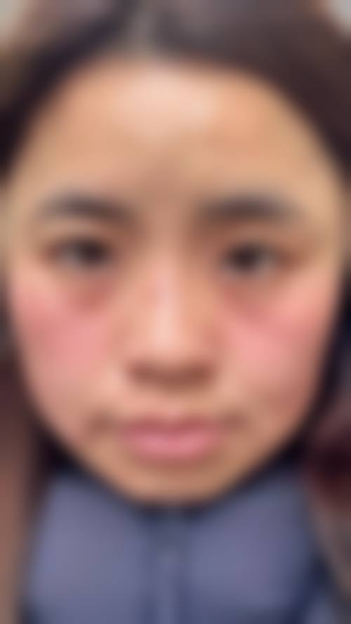 五、北京如颜惠芳整形医院实例