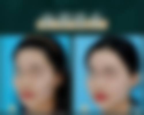 广州高尚医学美容中 心李春明的术后保护服务