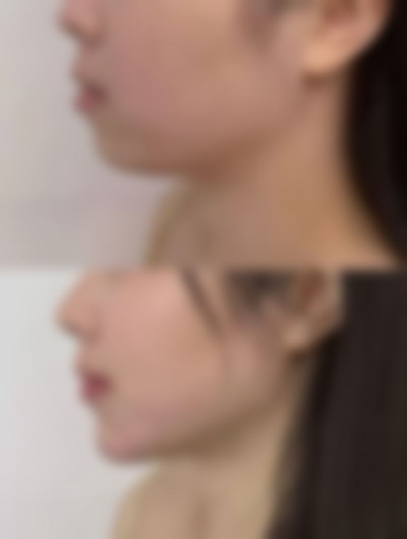 打隆鼻成效究竟美不美？注射隆鼻优势多