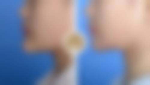 腰腹抽脂暗藏哪些隐患之其他危害揭秘