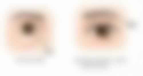 瘢痕体质激光治疗：依据瘢痕病情程度的建议与好处