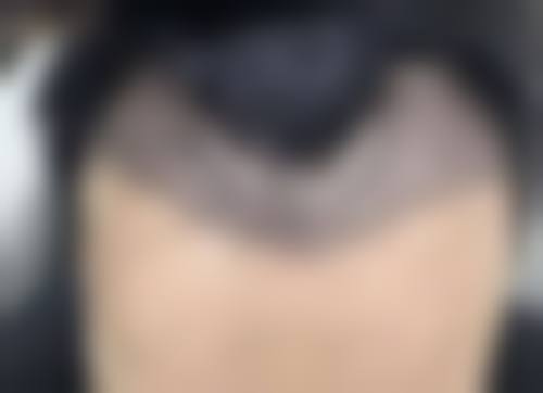 除皱针注意要点大揭秘！术后其他护理与成效维持