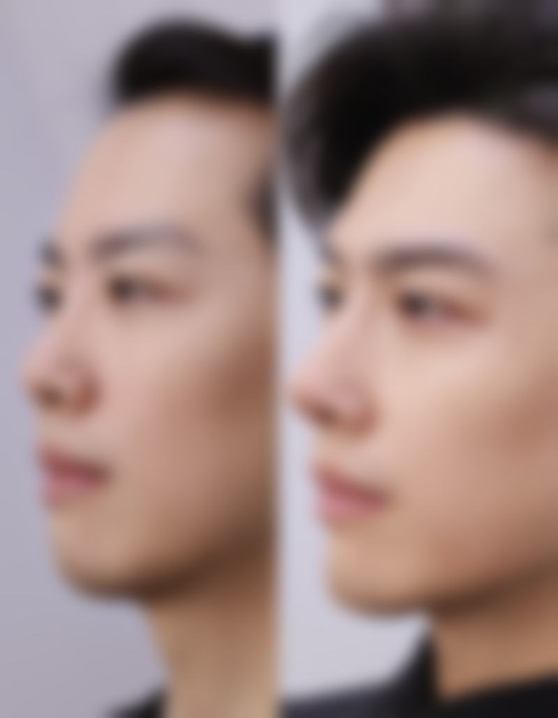 联合手术有哪些建议？根据眼部问题合理搭配