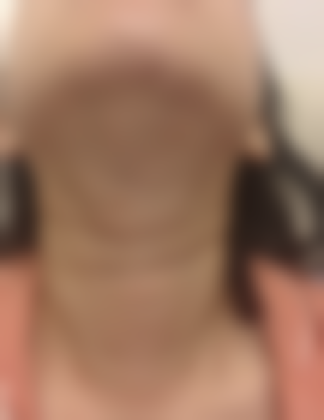 不敢扎发的35岁女生，在贵阳利美康找周医生做颈纹淡化，8800元3次见效服务贴心