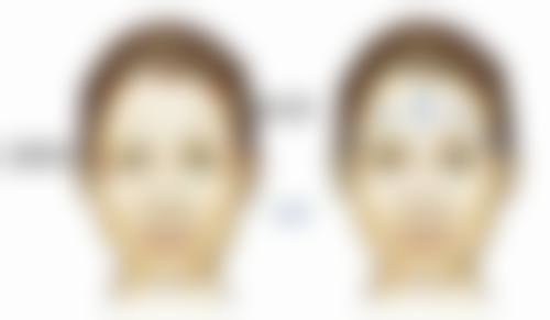 哪种方法去除眼袋好？多种方案适配不同人群，实现微创恢复快、效果持久！ 
