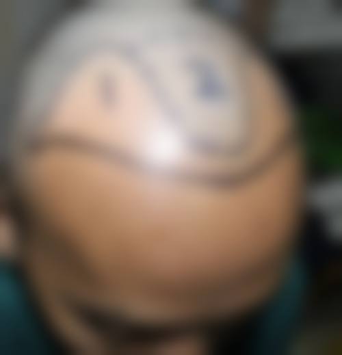 七、重庆厚森植发价格表:(仅供参考)