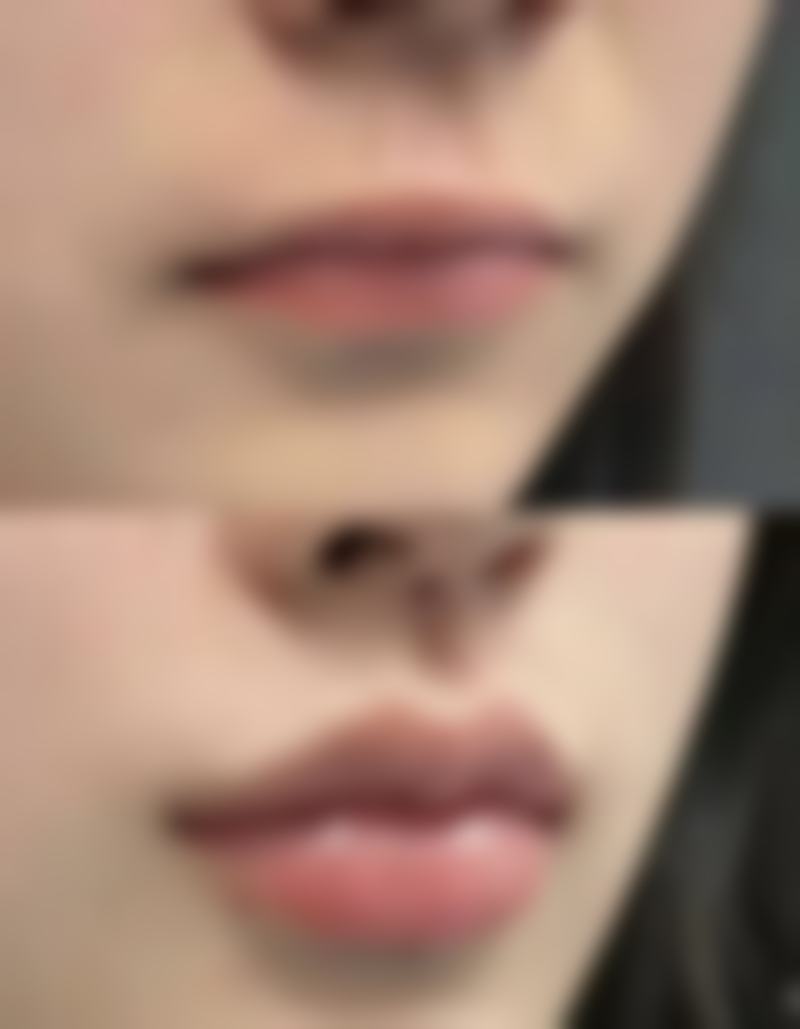 探寻假体隆胸后背挺不直的具体诱因