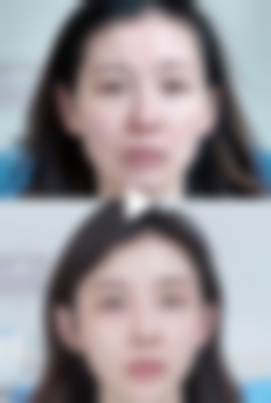 假体隆胸后背挺不直正常吗？揭秘诱因、护理要点，助你恢复挺拔身姿 