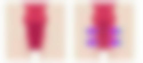 哪些因素会影响疤痕增生软化时间?