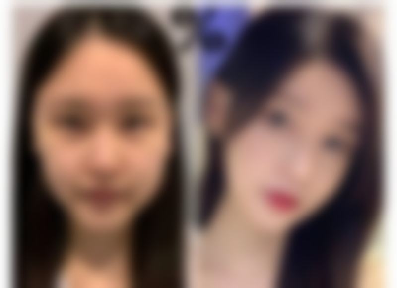 切开双眼皮特殊情况及调整方案:多数3 - 20年,修复让美持续在线