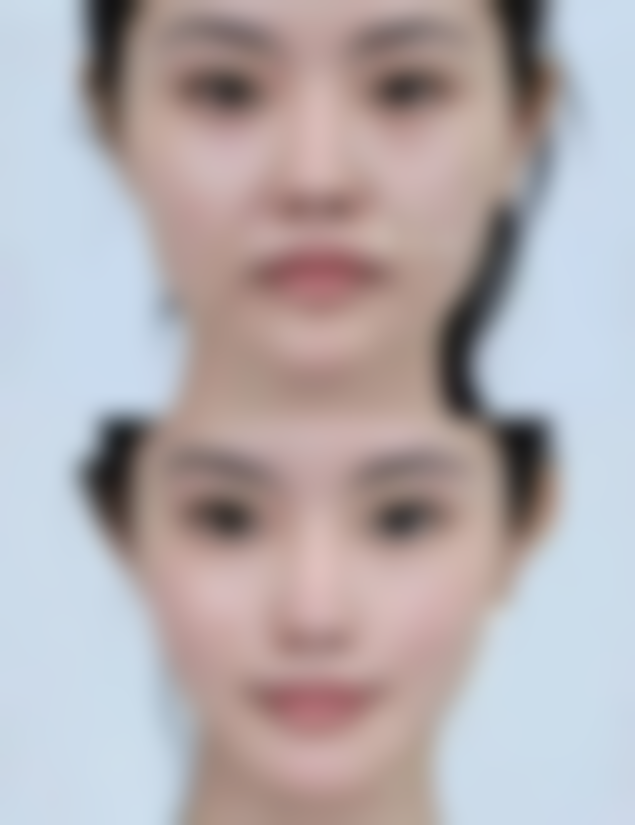 面部缝合疤痕去除：手术治疗解难题