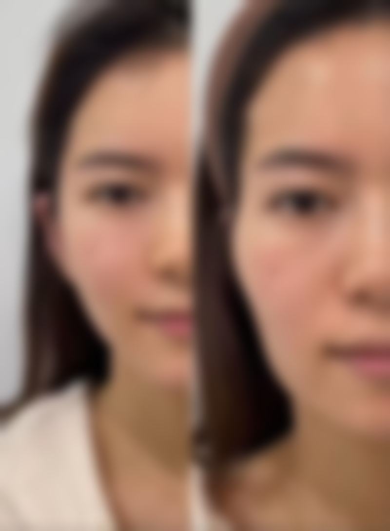 面部缝合疤痕去除：激光治疗有妙招