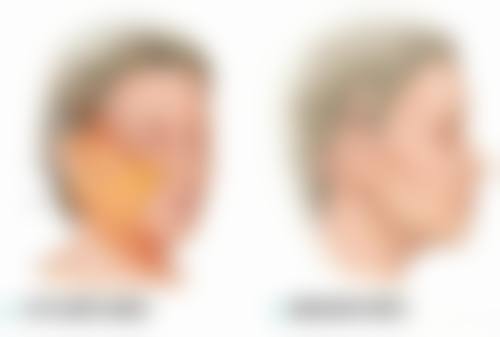 隆鼻线雕到底要不要取出？揭晓不同情况的处理办法及术后护理要点 