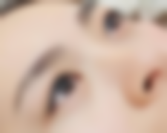 其他祛眼袋妙招之医美治疗项目