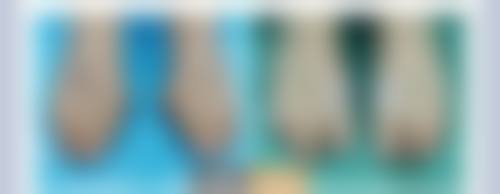 去眼袋眼下细纹：按成因定制改善方案