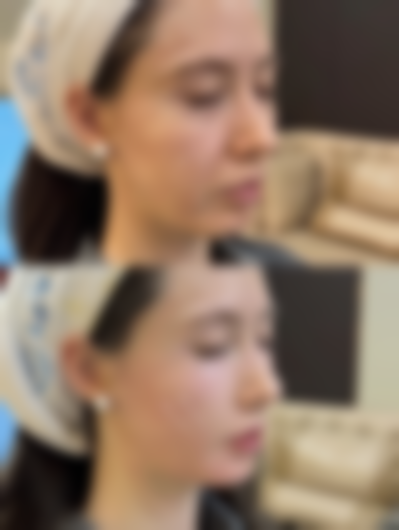 脸上凹疤有办法，微晶磨皮来美化