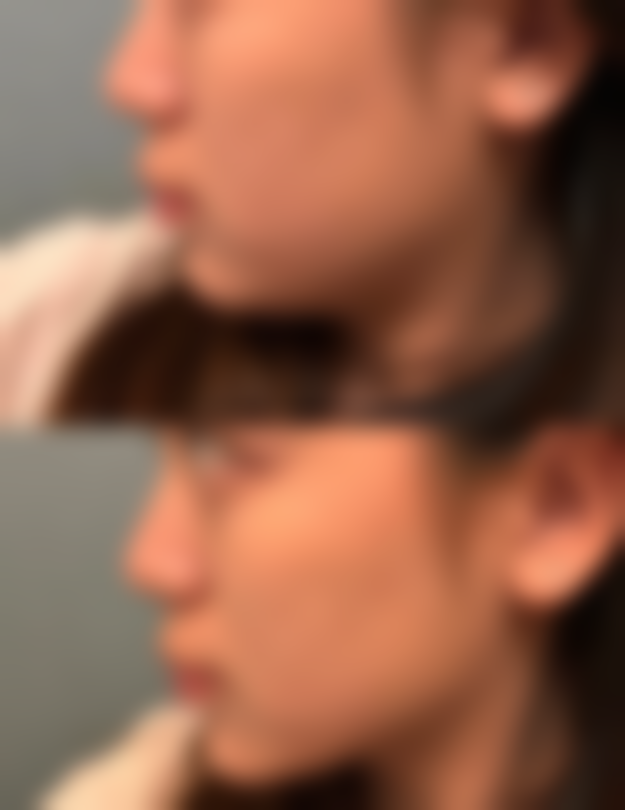 总结肿胀时长奥秘，开启美丽蜕变之旅