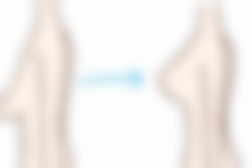 疤痕增生做光子嫩肤的术后反应与护理