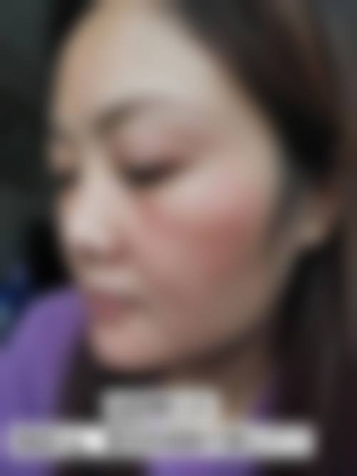 五、南京光尔美整形医院实例