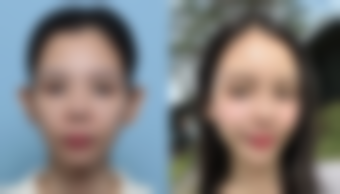 光子嫩肤对疤痕增生的作用原理