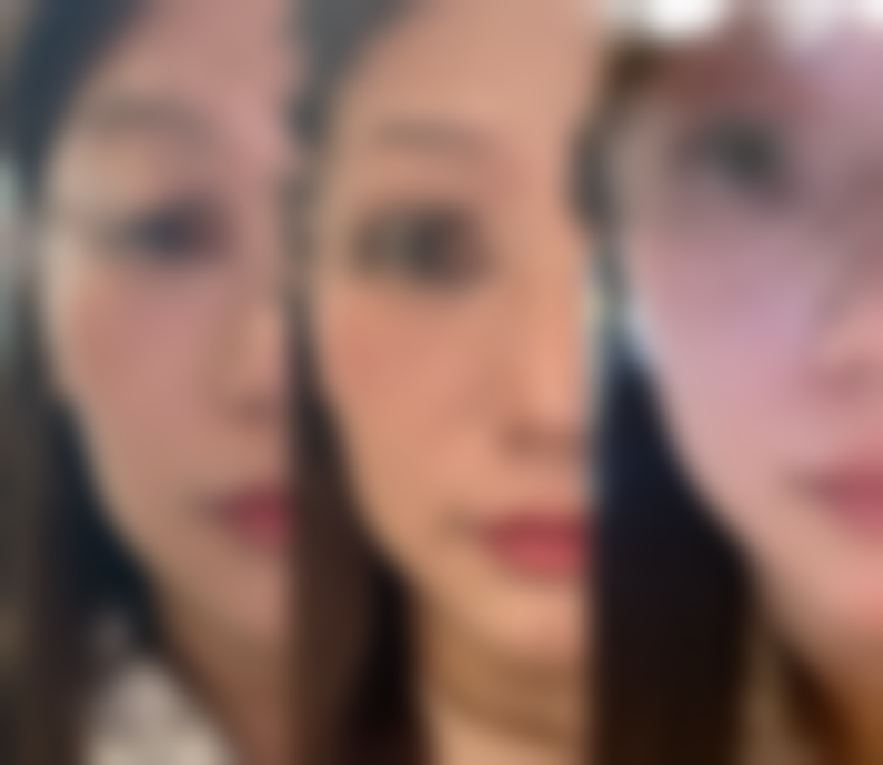 疤痕增生做光子嫩肤的优势