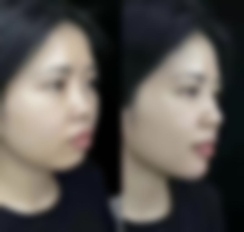 假体隆胸大揭秘：适用人群各有千秋