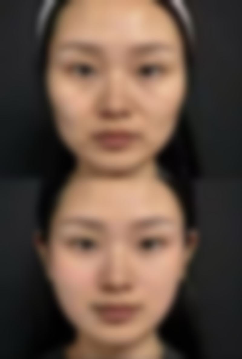 五、合肥市第二人民医院整形美容科实例