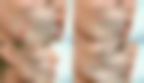 甲亢手术疤痕如何完美恢复？多维度修复+精细护理助您重塑平滑肌肤
