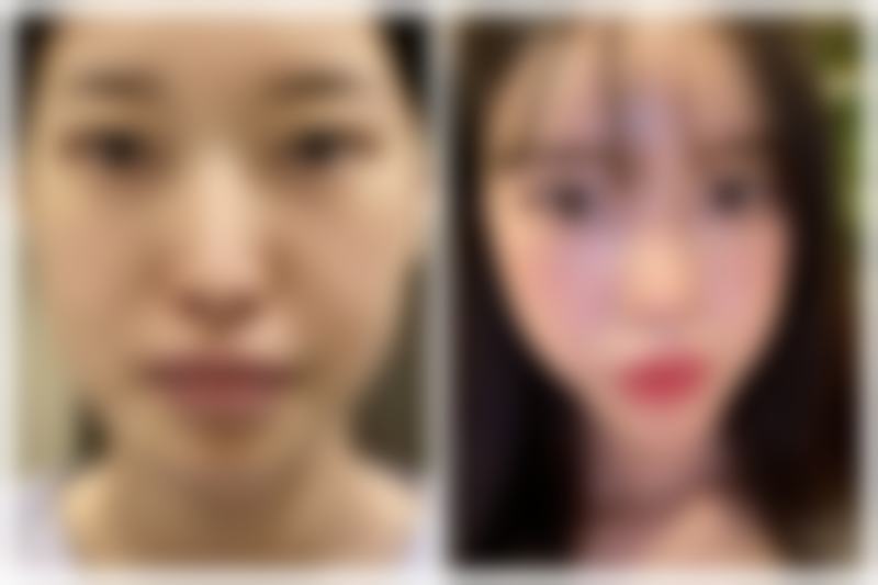 甲亢手术疤痕理想修复：把握修复时机