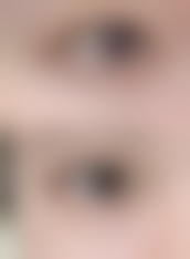 什么叫无痕去眼袋？——主要方式全知晓