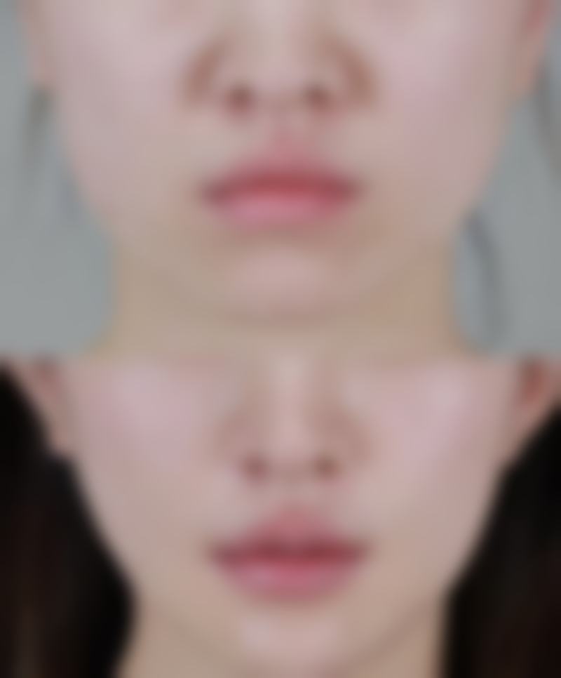 去完眼袋却有皱纹？别慌！多种改善方案+术后护理助你重焕眼周紧致光彩