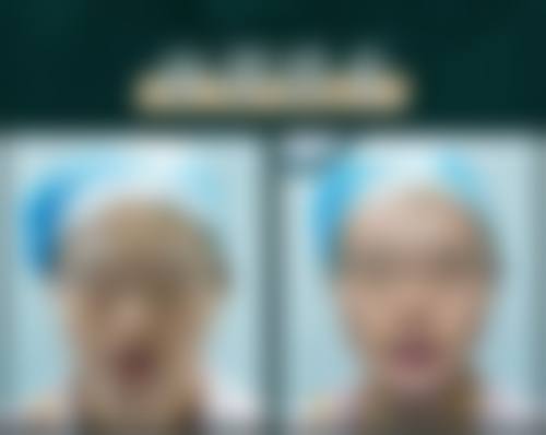 广州高尚医学美容中 心李翠华医生在超声 刀与热玛吉方面的专精科普优势